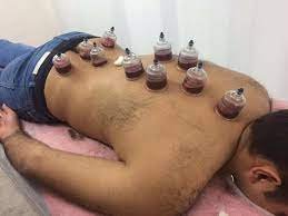 اخصائي مساج بالكاسات في الرياض